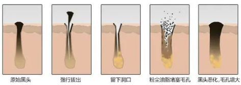 如何去黑頭？為什么要定期做去黑頭管理？VN給你好的答案